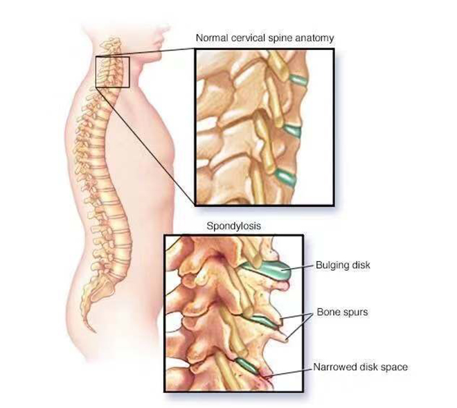 颈椎2.jpg
